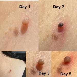 新手脱疣篇•下集